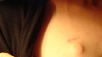 Necessary Evil: The Port-o-cath, Part II