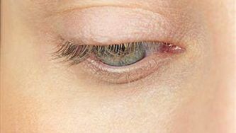 Glaucoma
