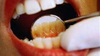 Gum disease