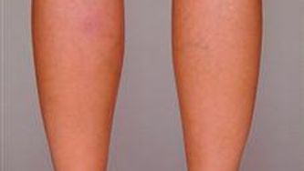 Varicose veins