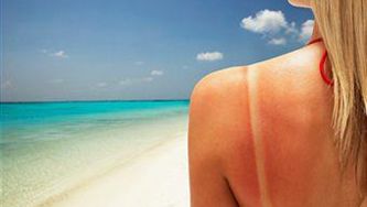 Sunburn