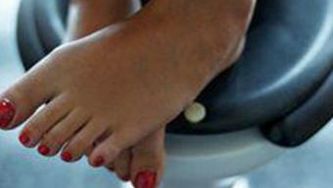 Interstitial cystitis (painful bladder syndrome)
