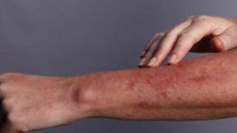 Shingles