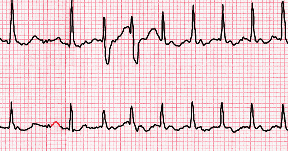 Heart palpitations: Should I be worried if my heartbeat is irregular? -  Chatelaine