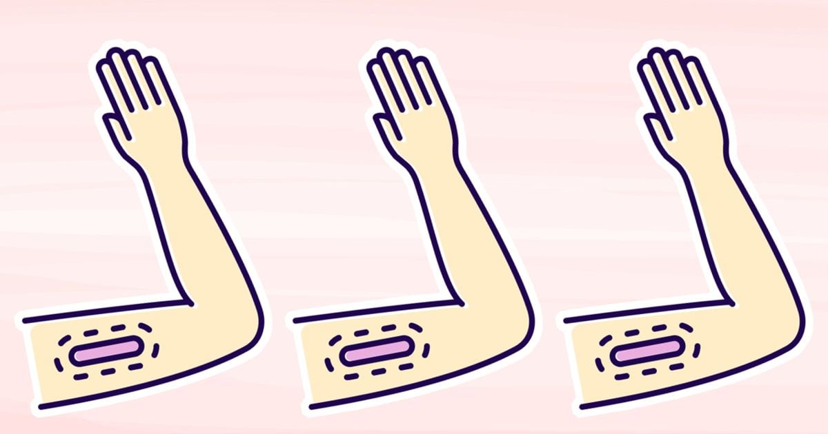 Health Canada Just Approved The Birth Control Arm Implant. What You