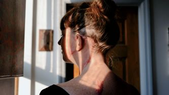 I've Had Skin Cancer—Over And Over Again